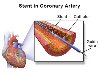 angioplasty