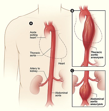 aneurisms