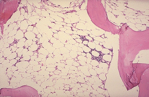 Aplastic anemia