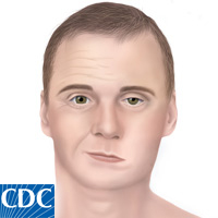 bells palsy cdc