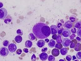 Chronic Myeloid Leukemia