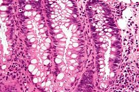 Cryptosporidiosis