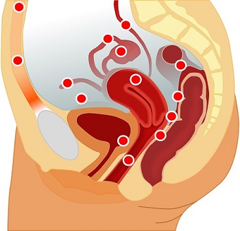 endometriosis