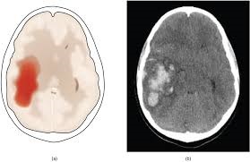 Hemorrhagic stroke