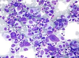 hodgkin's lymphoma