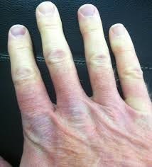 Raynaud's disease