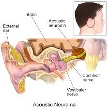 acoustic neuroma