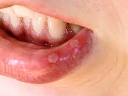 aphthous ulcers