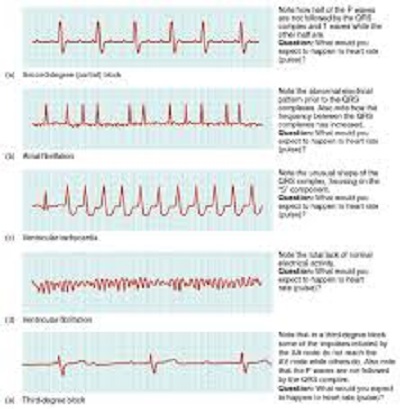 arrhythmia