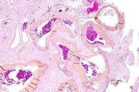 arteriovenous malformations