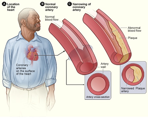 Atherosclerosis