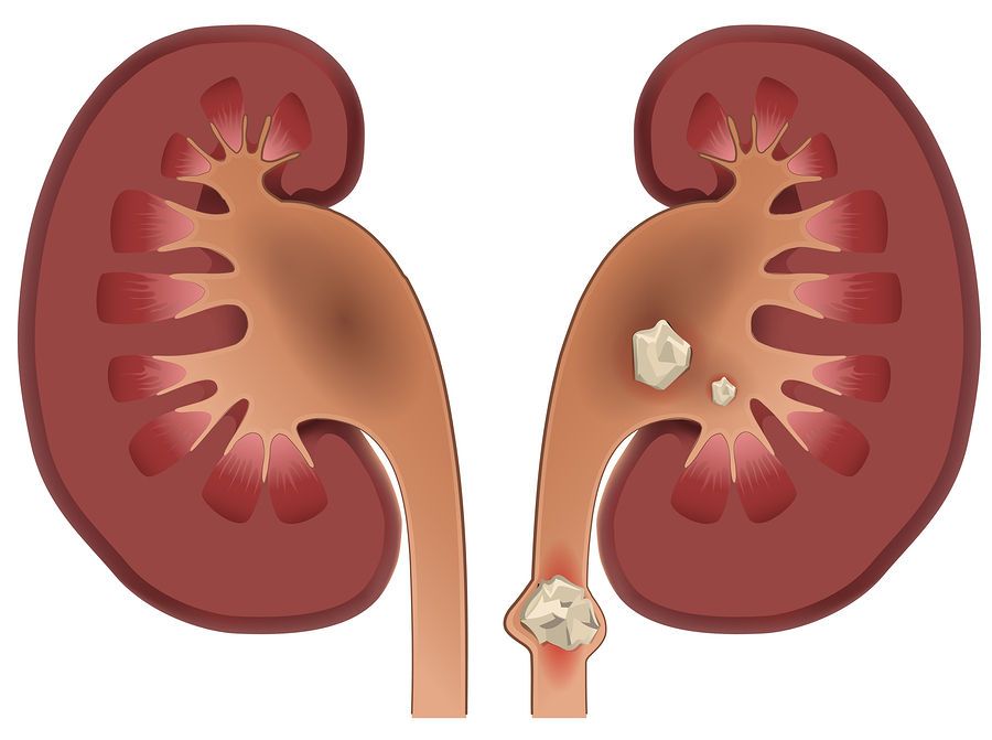 kidney stones