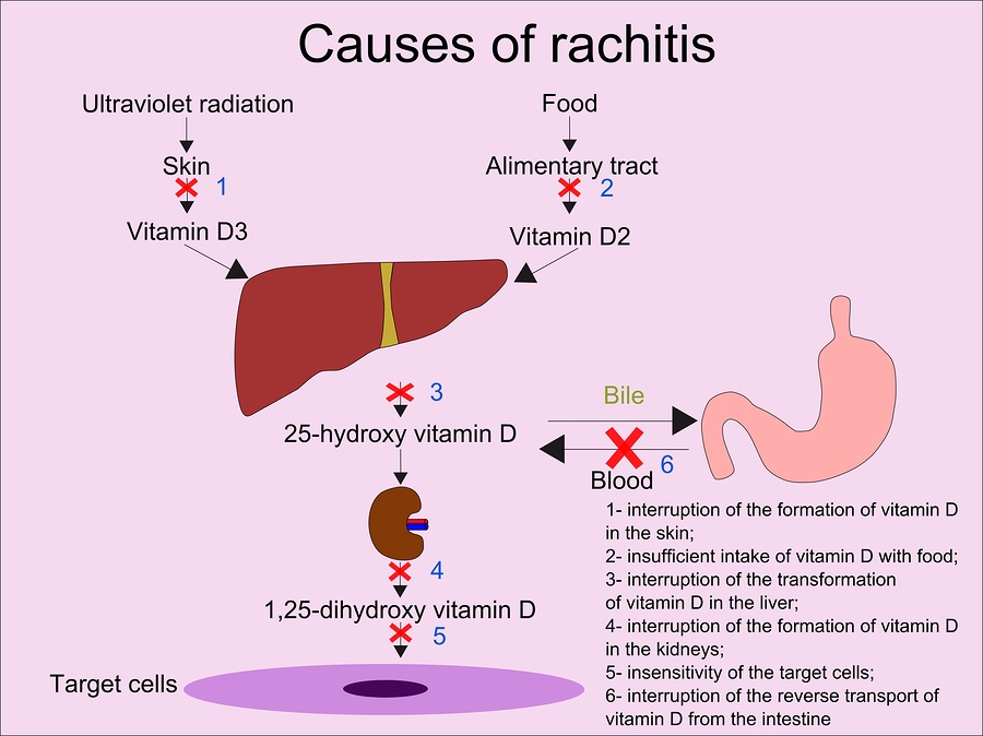 rahitis