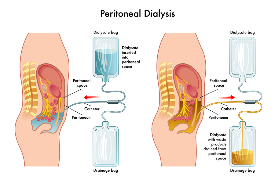 peritoneal dialysis