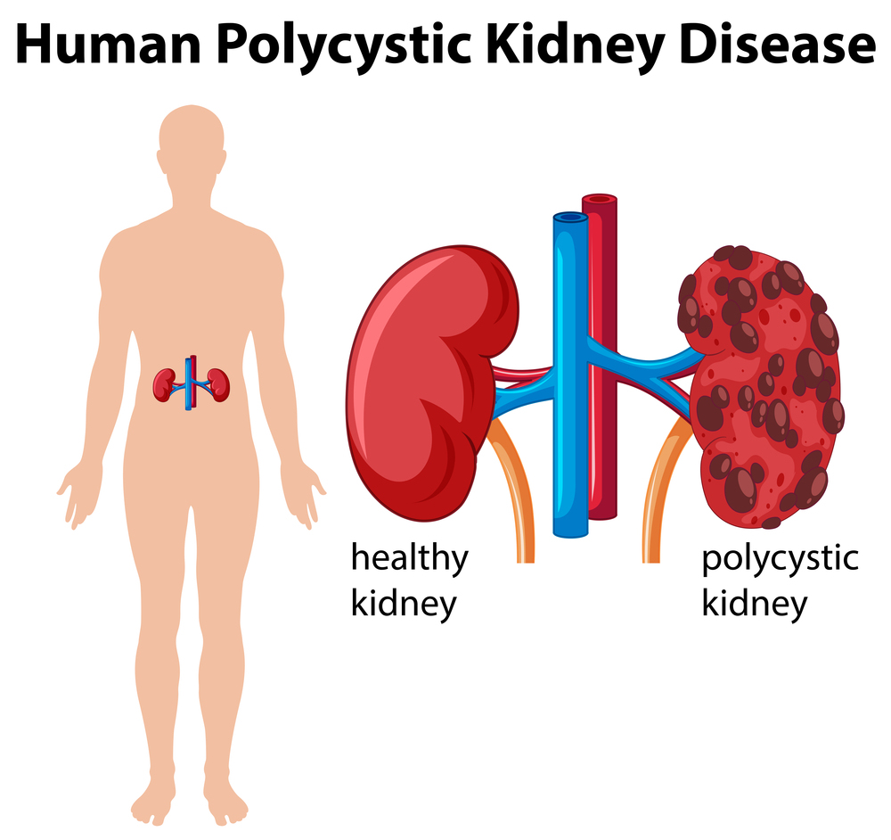 Kidney Cysts