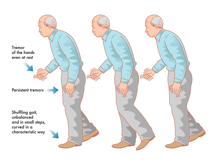 Movement Disorders