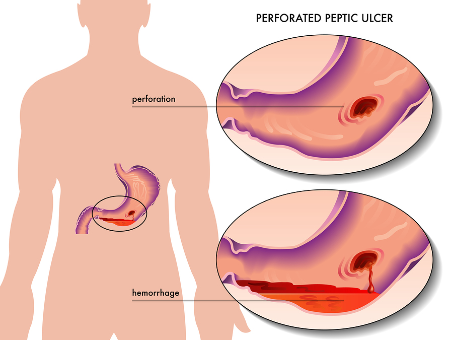 Peptic Ulcer