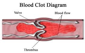 blood clot