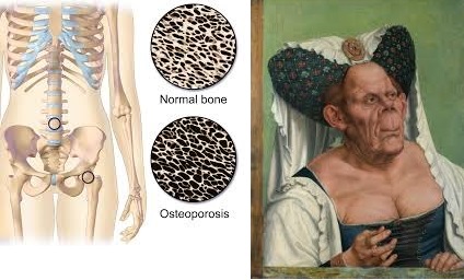 bone diseases