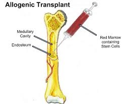 bone transplant