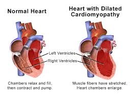 cardiomyopathy