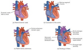 congenital heart disease