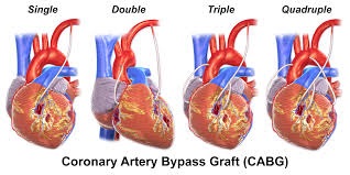 coronary artery bypass