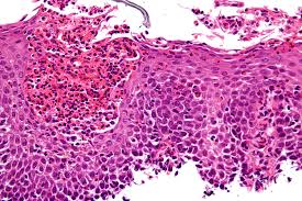 eosinophilic disorders