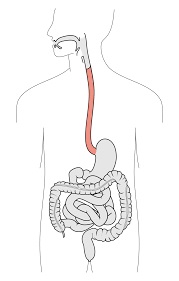 esophageal disorders