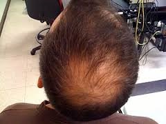 hair loss