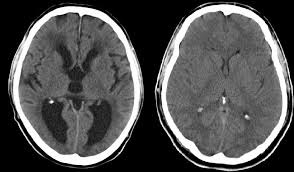 hydrocephalus