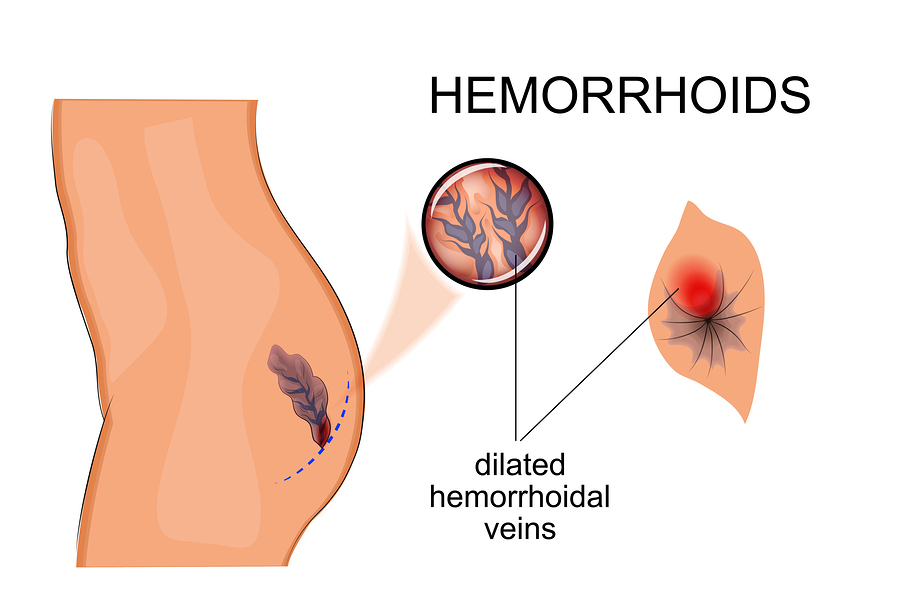 hemorrhoids treatment