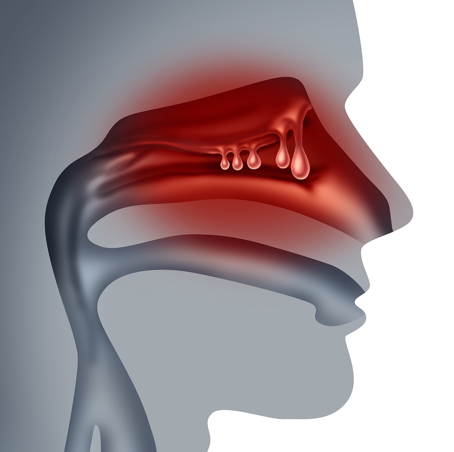 sinusitis infographic