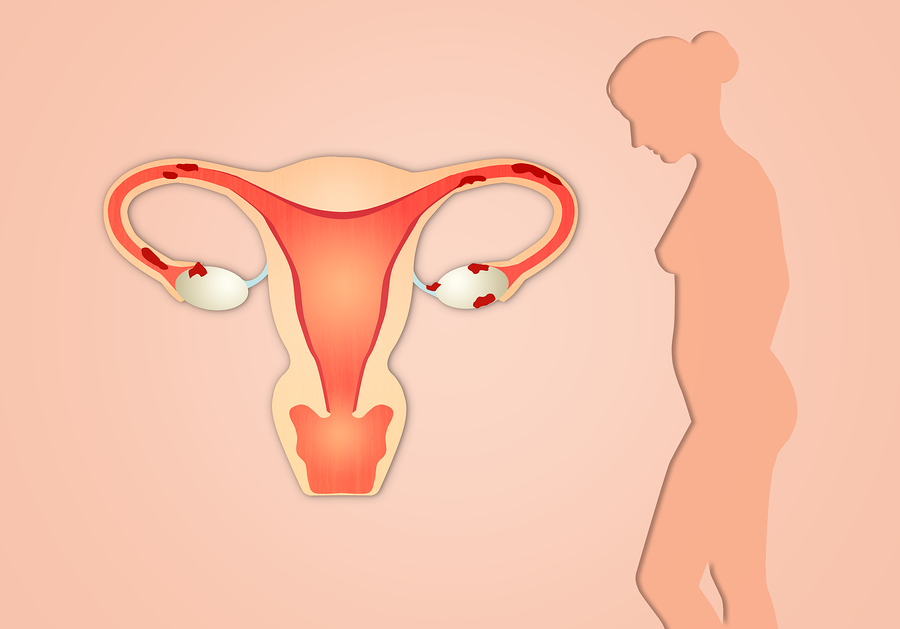 infertility endometriosis