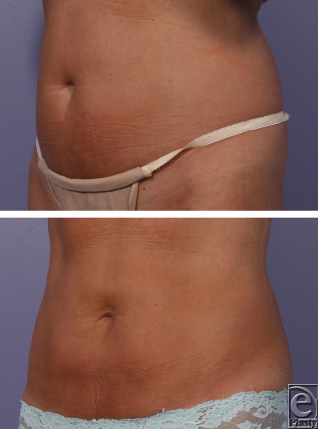 Cryolipolysis case