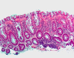 intestinal polyps