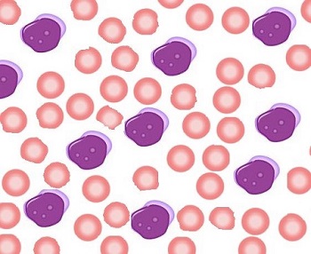 leukemia