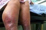 lymphedema