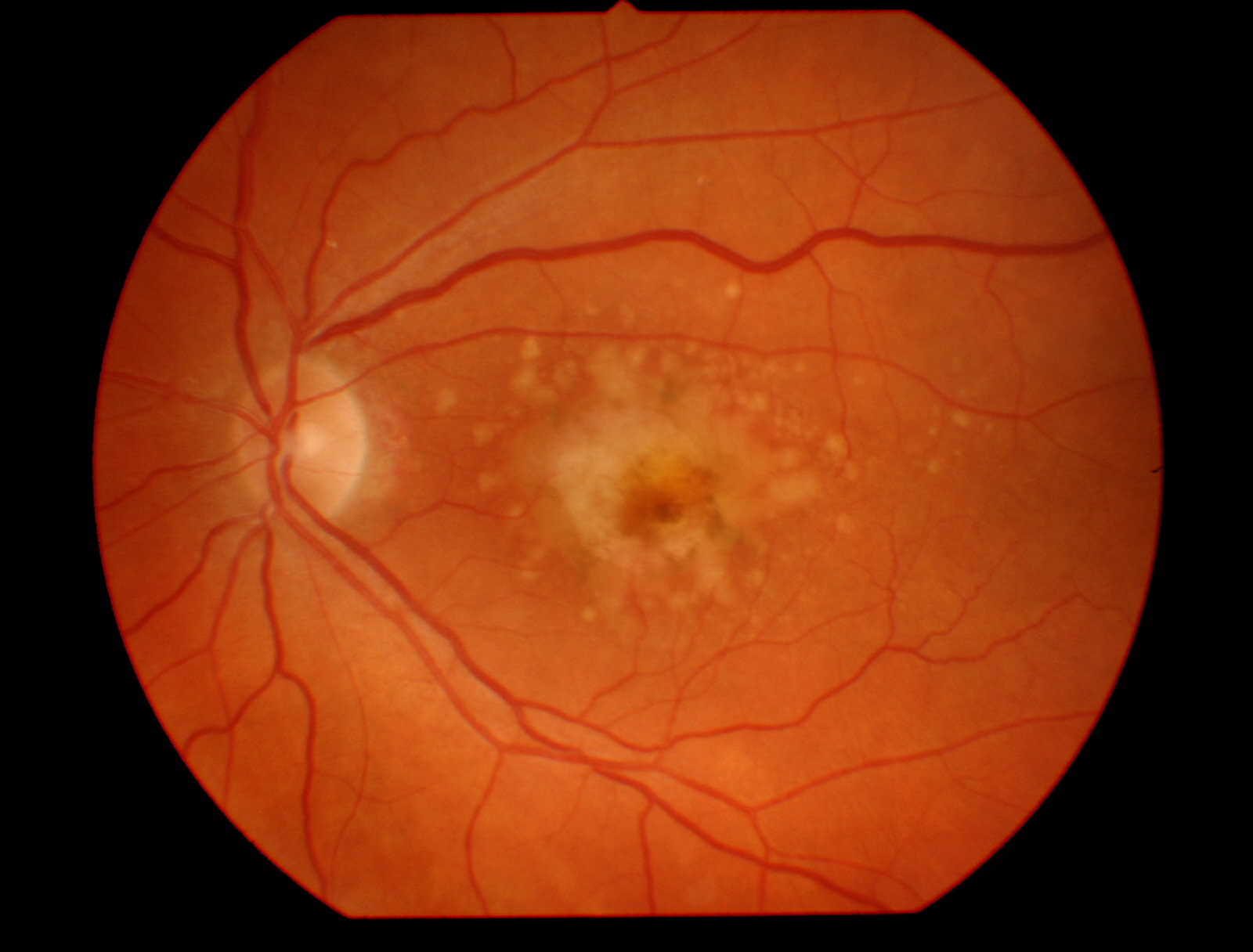 eye AMD stages