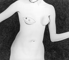 mastectomy