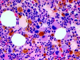 myelodysplastic syndromes