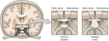 pituitary tumors