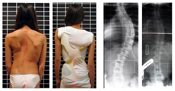 scoliosis