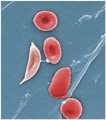 sickle cell anemia