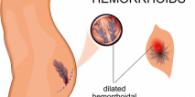 Hemorhoids diagnosis