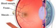 Macular degeneration