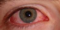 Pink eye