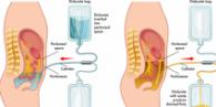 peritoneal dialysis