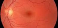 Retina Detachment