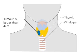 thyroid cancer